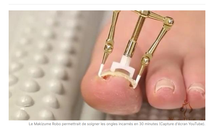 Un redresseur d'ongle d'orteil (capture écran Phrenssynnes)